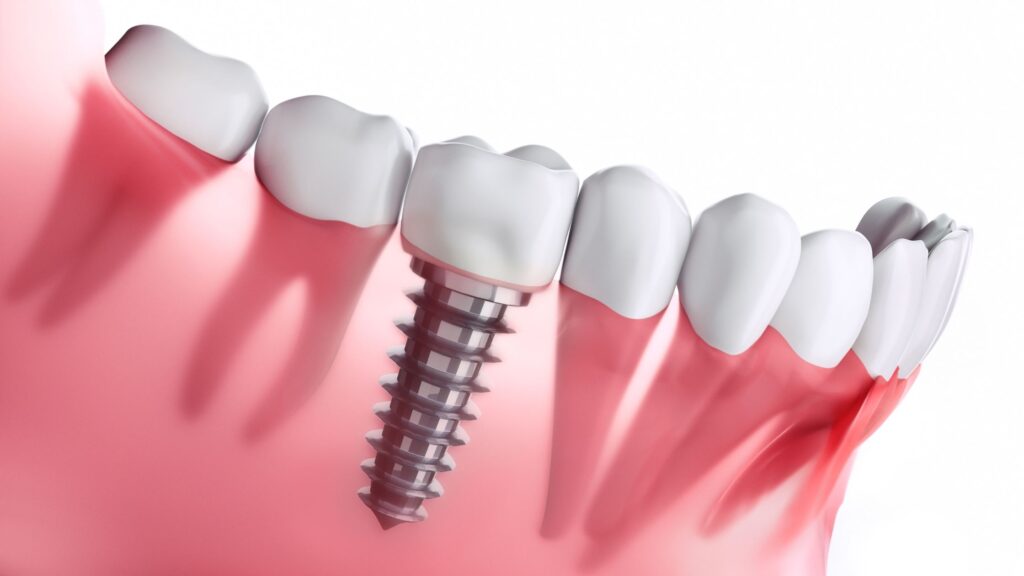 best dental implants in junagadh